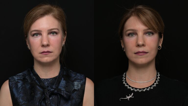 Facelift | Neck Lift 57 - Age: 45-50
Procedure: Deep Plane Face & Neck Lift
Results at: 1 year