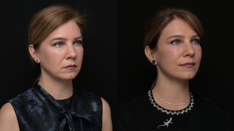 Facelift | Neck Lift 57 - Age: 45-50
Procedure: Deep Plane Face & Neck Lift
Results at: 1 year