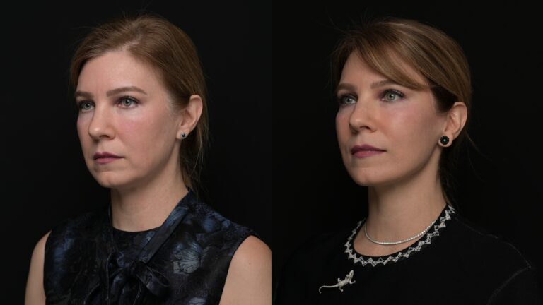 Facelift | Neck Lift 57 - Age: 45-50
Procedure: Deep Plane Face & Neck Lift
Results at: 1 year