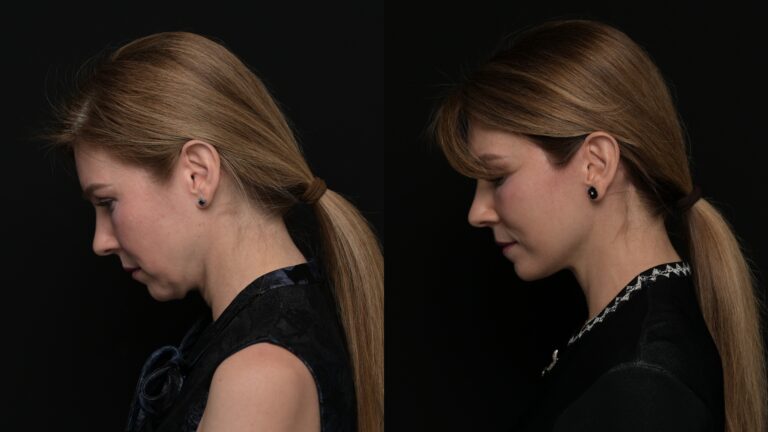 Facelift | Neck Lift 57 - Age: 45-50
Procedure: Deep Plane Face & Neck Lift
Results at: 1 year