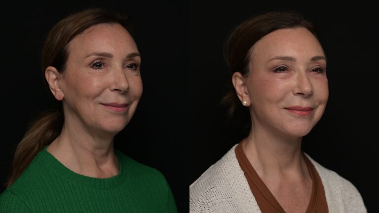 Facelift | Neck Lift 61 - Age: 70-75
Procedure: Deep Plane Facelift, Deep Neck Contouring, Lower Blepharoplasty
Results at: 1 month