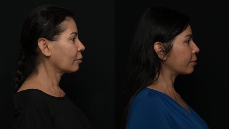 Facelift | Neck Lift 62 - Age: 55-60
Procedure: Deep Plane Facelift, Deep Neck Lift
Results at: 1 year