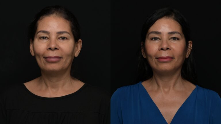 Facelift | Neck Lift 62 - Age: 55-60
Procedure: Deep Plane Facelift, Deep Neck Lift
Results at: 1 year