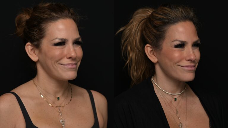 Facelift | Neck Lift 67 - Age: 45-50
Procedure: Deep Plane Facelift, Deep Neck Lift
Results at: 4 months