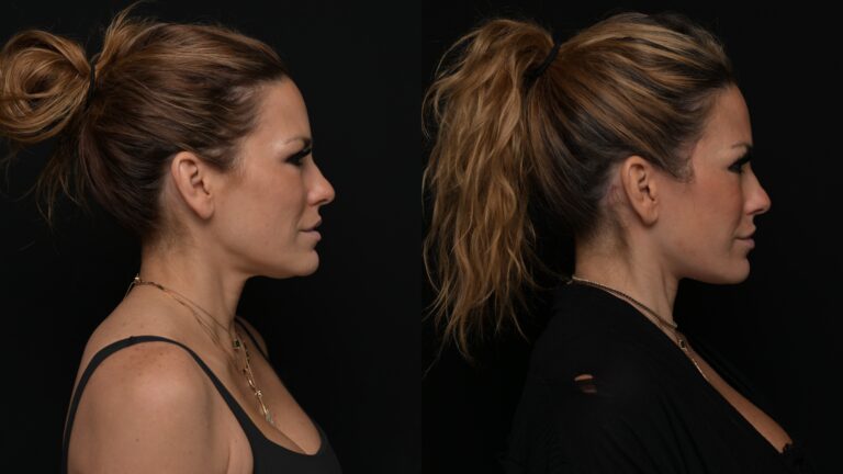 Facelift | Neck Lift 67 - Age: 45-50
Procedure: Deep Plane Facelift, Deep Neck Lift
Results at: 4 months