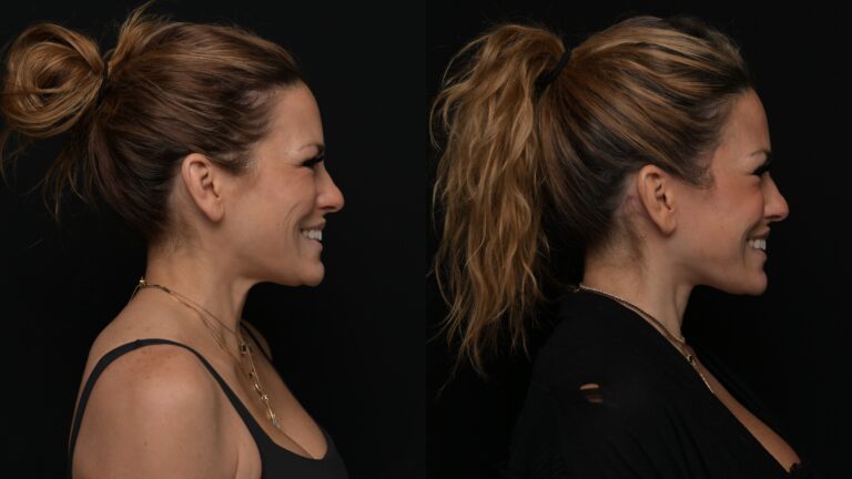 Facelift | Neck Lift 67 - Age: 45-50
Procedure: Deep Plane Facelift, Deep Neck Lift
Results at: 4 months