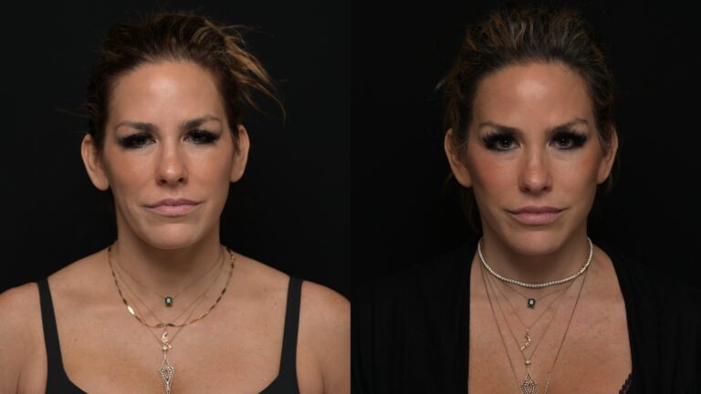 Facelift | Neck Lift 67 - Age: 45-50
Procedure: Deep Plane Facelift, Deep Neck Lift
Results at: 4 months