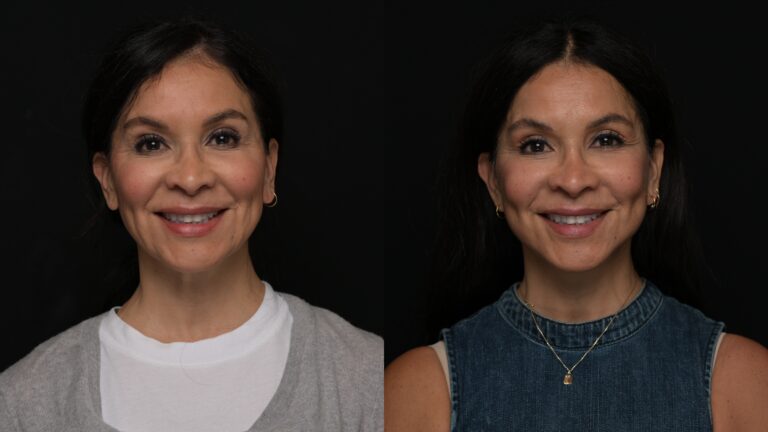 Facelift | Neck Lift 68 - Age: 60-65
Procedure: Deep Plane Facelift, Deep Neck Lift
Results at: 3 months