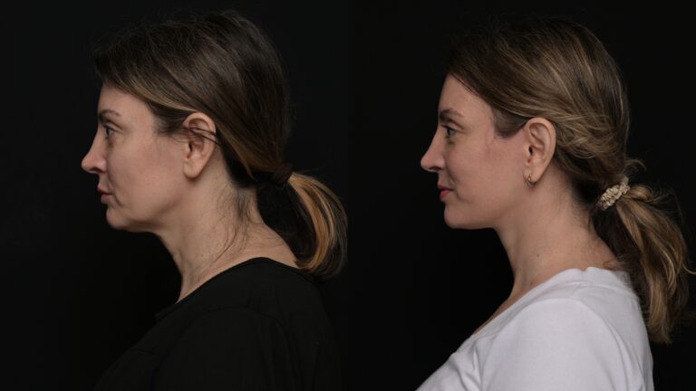 Facelift | Neck lift 64 - Age: 55-60
Procedure: Deep Plane Facelift, Deep Neck Lift
Results at: 6 months
