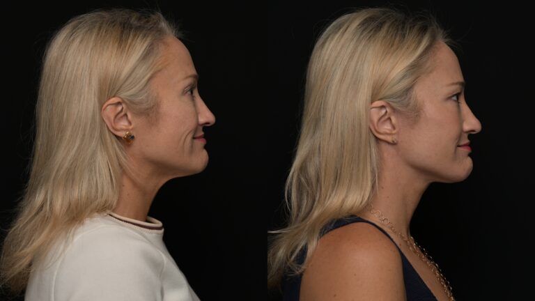 Facelift | Neck Lift 72 - Age: 45-50
Procedure: Deep Plane Facelift, Deep Neck Lift
Results at: 3 months